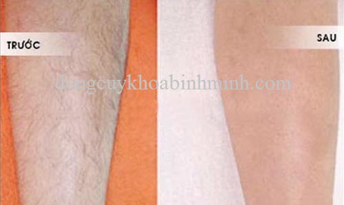 cách tẩy lông chân